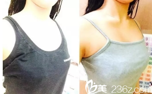 韩国jk整形外科医院做隆胸手术真人案例 韩国jk整形外科医院做隆胸手术真人案例