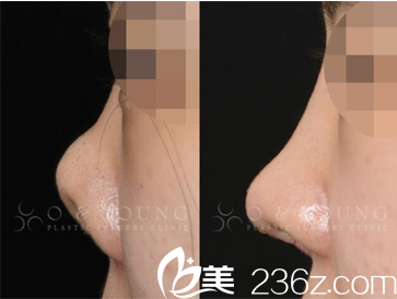 在韩国O&YOUNG整形花42000元做的鼻部修复，吴荣焕院长案例