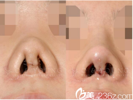 韩国O&YOUNG整形外科案例 韩国O&YOUNG整形外科案例