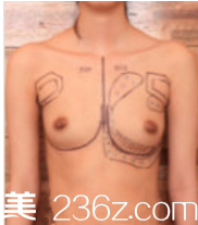 韩国棒棒(BONGBONG)整形外科案例 韩国棒棒(BONGBONG)整形外科案例