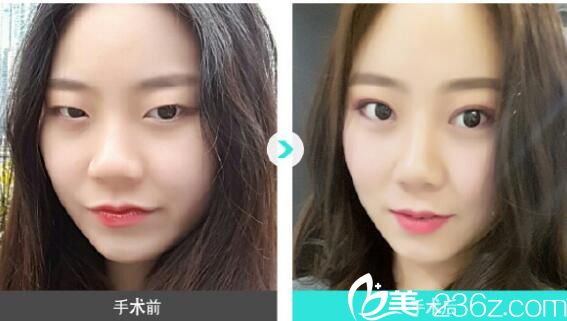 金志桓双眼皮案例