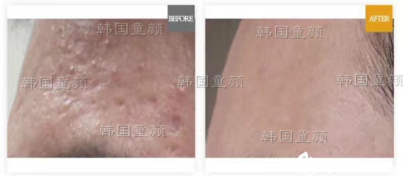 韩国童颜皮肤中心祛痘案例