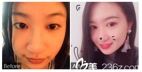 广州健丽医疗美容张晨光双眼皮案例