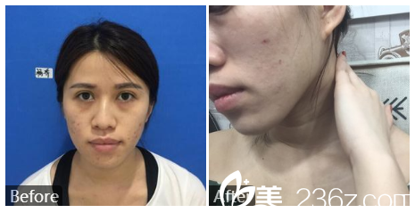 广州健丽医疗美容张晨光皮肤美容案例