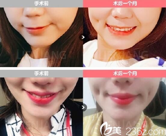 郑贤煜酒窝成形术案例 郑贤煜酒窝成形术案例