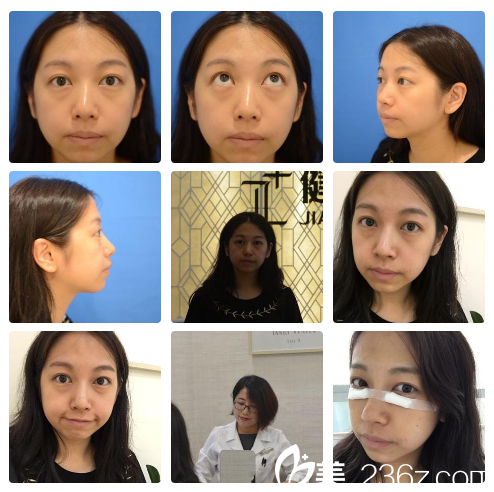 祛眼袋术前照片 祛眼袋术前照片