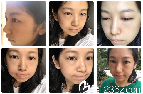 在广州健丽医美做完祛眼袋第二天生活照 在广州健丽医美做完祛眼袋第二天生活照