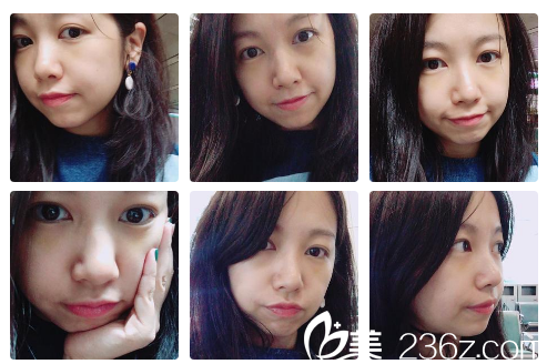 找曹宝济院长做完祛眼袋4天了 找曹宝济院长做完祛眼袋4天了