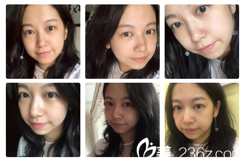 曹宝济院长祛眼袋7天<span style= 曹宝济院长祛眼袋7天<span style=