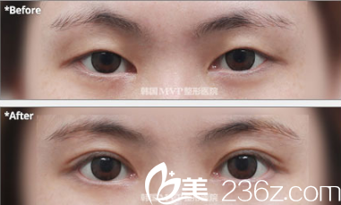 韩国MVP整形外科医院案例 韩国MVP整形外科医院案例