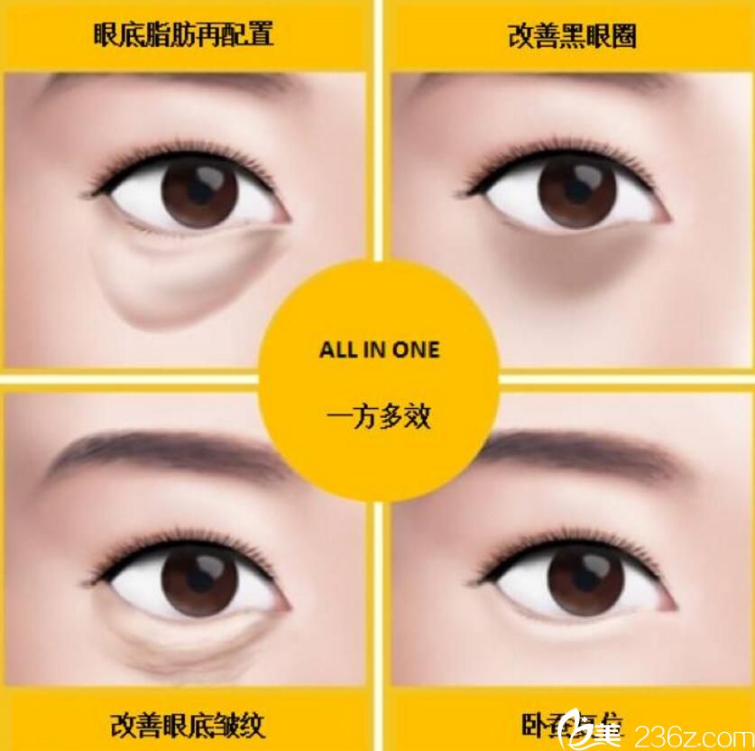 眼底脂肪再配置- 轻松无痕祛除眼袋 眼底脂肪再配置- 轻松无痕祛除眼袋