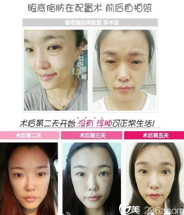 张荣佑眼底脂肪再配置术案例 张荣佑眼底脂肪再配置术案例