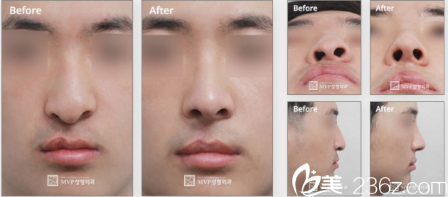 韩国MVP整形外科医院案例