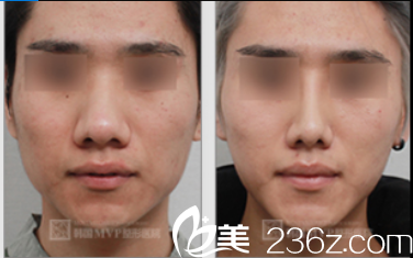 韩国MVP整形外科医院案例