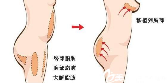 韩国PROPOSE整形医院自体脂肪隆胸 韩国PROPOSE整形医院自体脂肪隆胸