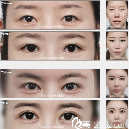 韩国MVP整形外科医院案例