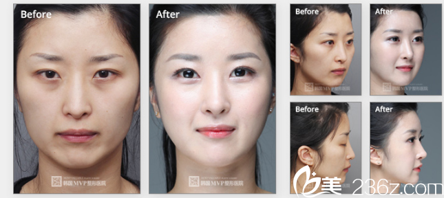韩国MVP整形外科医院案例