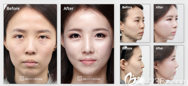 韩国MVP整形外科医院案例