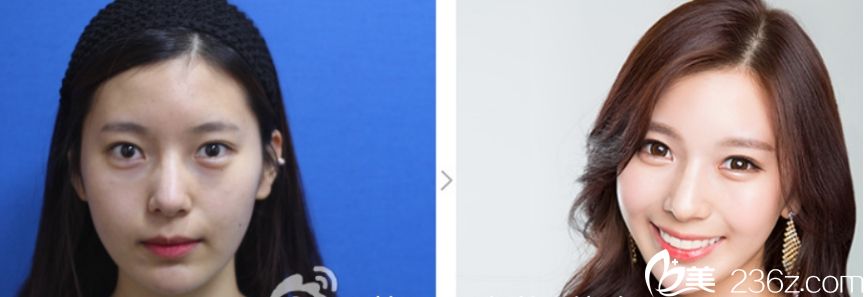 丽延长做童颜微整、面部提升效果怎么样?卧蚕玻尿酸+ 玻尿酸隆鼻+玻尿酸垫下巴+瘦脸+轮廓针+贵族手术真人案例 丽延长做童颜微整、面部提升效果怎么样?卧蚕玻尿酸+ 玻尿酸隆鼻+玻尿酸垫下巴+瘦脸+轮廓针+贵族手术真人案例