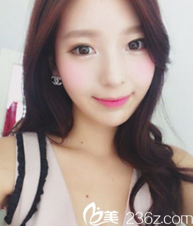 丽延长卧蚕玻尿酸+ 玻尿酸隆鼻+玻尿酸垫下巴+瘦脸+轮廓针+贵族手术真人案例 丽延长卧蚕玻尿酸+ 玻尿酸隆鼻+玻尿酸垫下巴+瘦脸+轮廓针+贵族手术真人案例