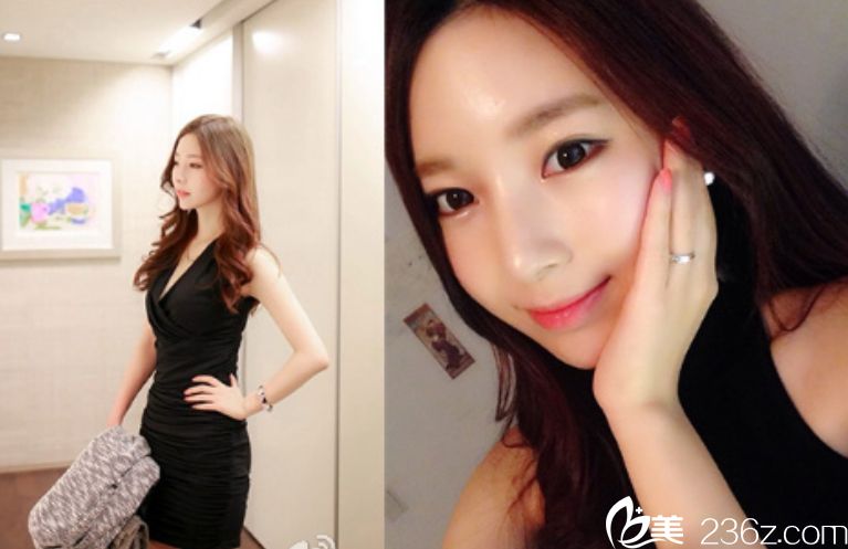 丽延长张院长卧蚕玻尿酸+ 玻尿酸隆鼻+玻尿酸垫下巴+瘦脸+轮廓针+贵族手术真人案例 丽延长张院长卧蚕玻尿酸+ 玻尿酸隆鼻+玻尿酸垫下巴+瘦脸+轮廓针+贵族手术真人案例