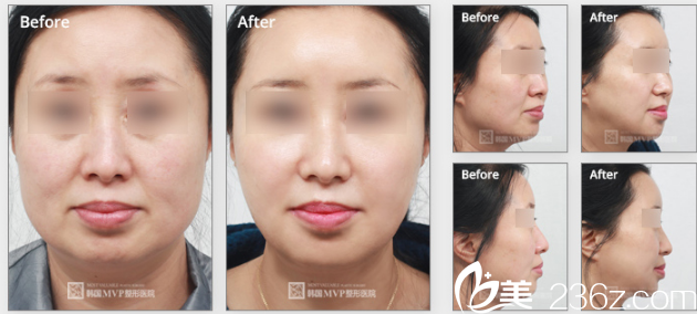 韩国MVP整形外科医院案例