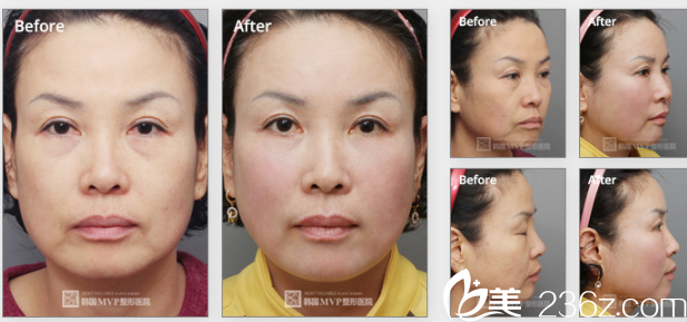 韩国MVP整形外科医院案例