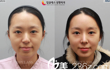 韩国TopClass整形外科医院金行准医生隆鼻手术案例