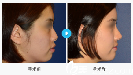 韩国MIGO整形外科医院案例 韩国MIGO整形外科医院案例