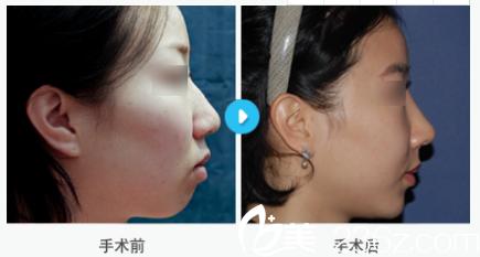 韩国MIGO整形外科医院案例 韩国MIGO整形外科医院案例