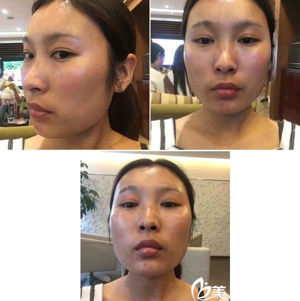 在艺星做假体隆鼻前的三连拍 在艺星做假体隆鼻前的三连拍