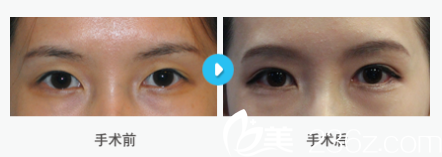 韩国MIGO整形外科医院案例