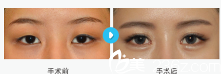 韩国MIGO整形外科医院案例