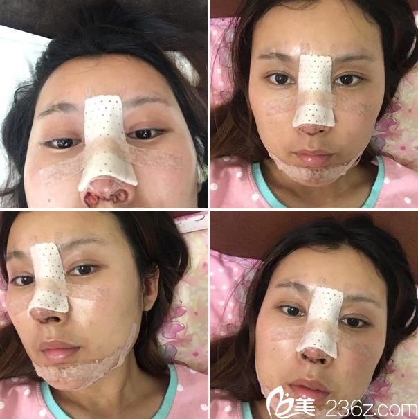 膨体隆鼻手术第3天和第4天自拍 膨体隆鼻手术第3天和第4天自拍