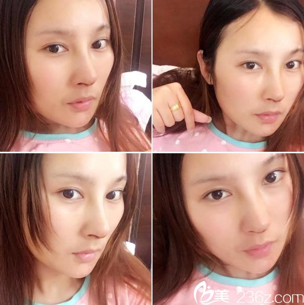 鼻综合BSK宫廷隆鼻手术7天拆线 鼻综合BSK宫廷隆鼻手术7天拆线