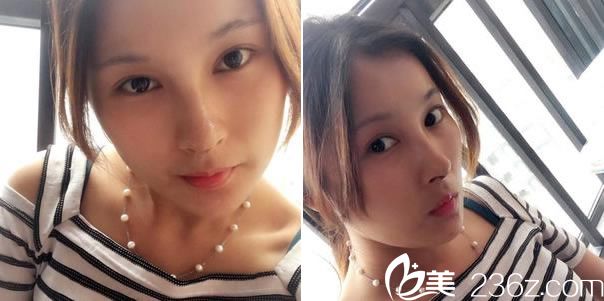 鼻综合整形手术第14天恢复图 鼻综合整形手术第14天恢复图