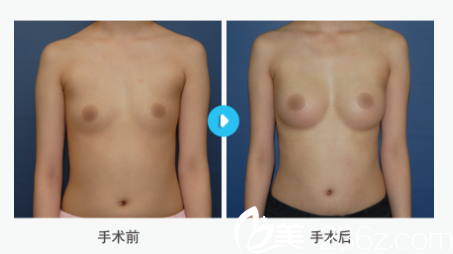 韩国MIGO整形外科医院案例