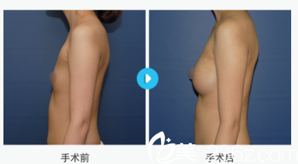 韩国MIGO整形外科医院案例