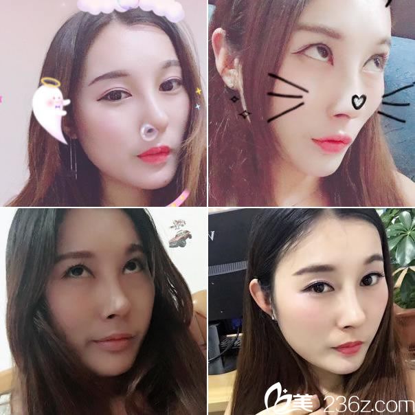 鼻综合和下巴整形手术60天<span style= 鼻综合和下巴整形手术60天<span style=