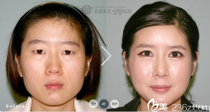 韩国PROPOSE整形医院金志昱做下巴缩小手术效果怎么样？方下巴缩小真人案例