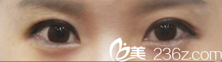 在韩国MIGO整形做切开双眼皮+内眼角一个月，高汉雄院长案例