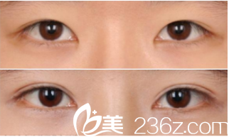 韩国MVP整形医院案例 韩国MVP整形医院案例