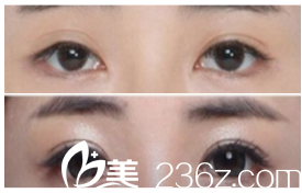 韩国MVP整形医院案例 韩国MVP整形医院案例