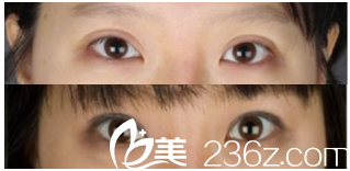 韩国MVP整形双眼皮修复怎么样？过宽多钱？玄炅倍院长案例