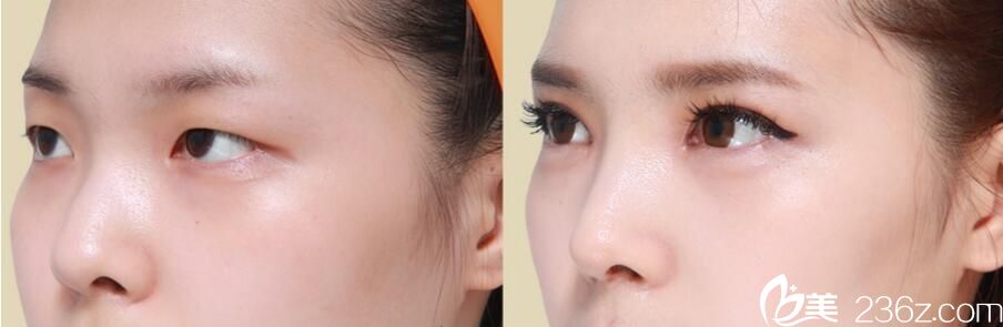 韩国佳轮韩整形外科朴鲁爀真人案例3