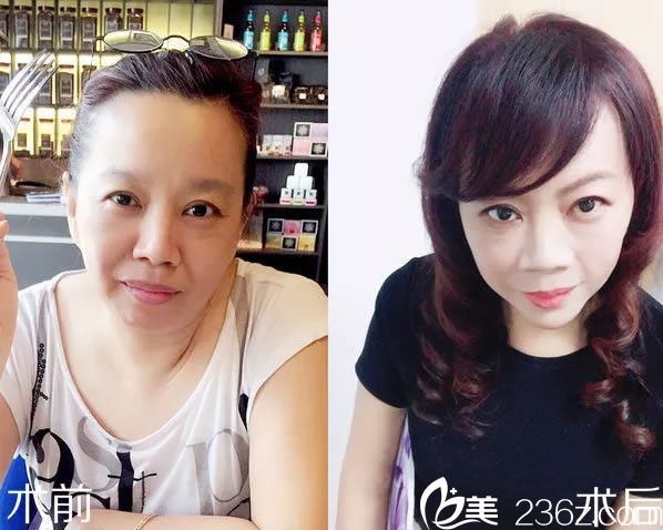 温州艺兴面部玻尿酸填充<span style=