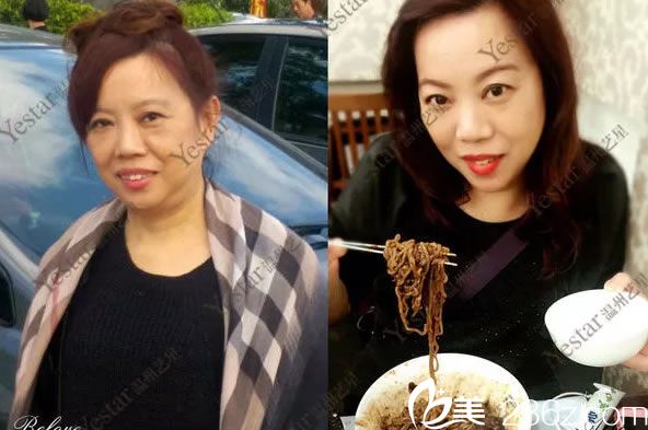 温州艺星做玻尿酸填充<span style=