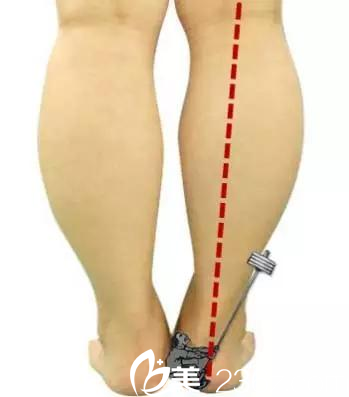 吸脂瘦小腿适用于脂肪型的小粗腿