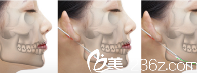 韩国ITEM（爱婷）整形医院脸部整形示意图