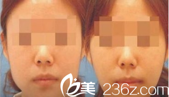 韩国ITEM(爱婷)整形医院案例 韩国ITEM(爱婷)整形医院案例